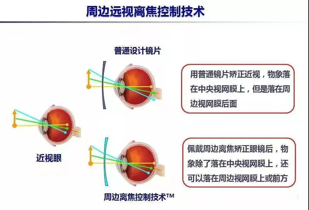 蔡司成长乐这种离焦镜片是如何达到近视防控效果的