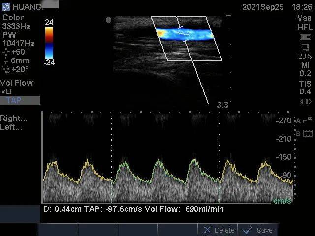 惠州|肾友的“透析生命线”堵了！关键时刻，一个电话解决了大难题
