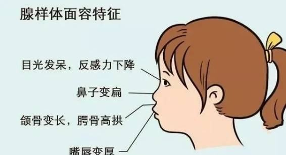 (點石師爺)王永月醫生教你正確認識兒童腺樣體肥大