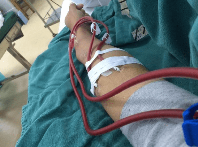 肾脏|养病如养虎，虎大必伤人——尿毒症