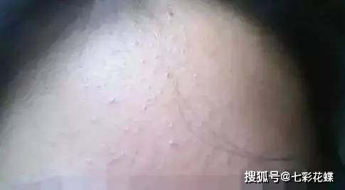下巴锐生老师护肤小课堂|：眼睛周围长满了脂肪粒？护理预防学习起来