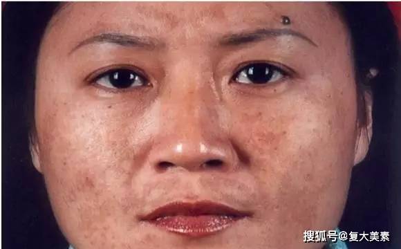 眼睛复大美素：要祛斑，这些色斑面诊原理你要懂！
