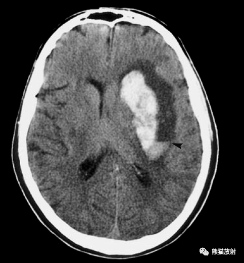 脑实质内出血丨演变分布ct表现