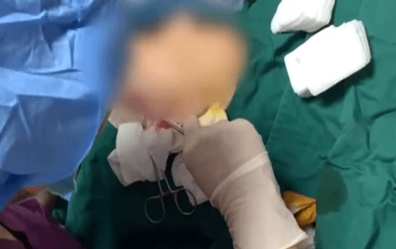 因为女子花1万元做拉皮手术导致面瘫,操刀人曾两次因非法行医被罚