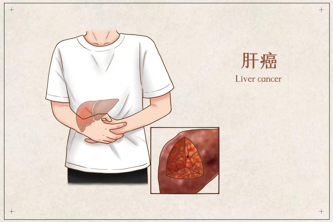 治疗|“肝癌名医在线”系列｜共话肝癌精准治疗新时代