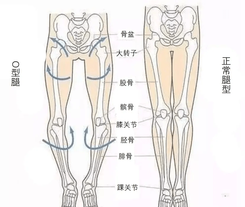 姐妹小腿粗？O型腿？没好好走路是元凶