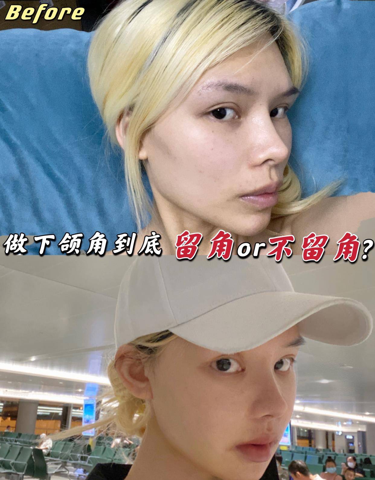 设计做下颌角到底留角or不留角？