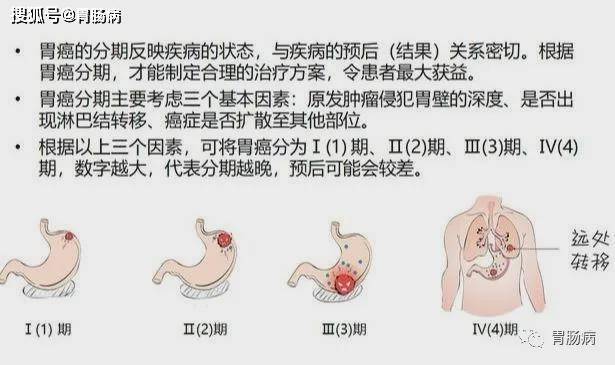 进而引起脉管浸润,远端转移,这就是进展期了;我们说的早期胃癌,就是