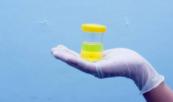 控制|糖尿病患者的尿又黄又骚是什么原因？你真的知道吗？看专家的理解