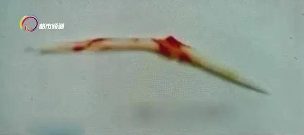 女士|警惕！鱼刺卡喉险丧命？就是因为用了这个“土办法”……