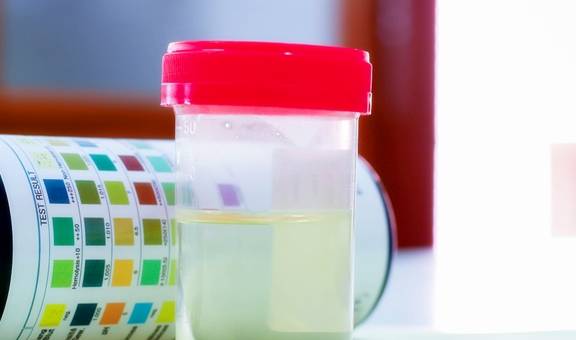 控制|糖尿病患者的尿又黄又骚是什么原因？你真的知道吗？看专家的理解