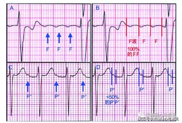 房扑的心电图表现图片