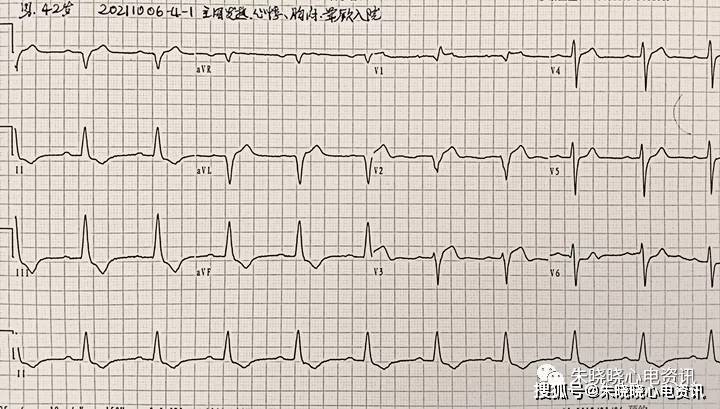 儿童心肌炎心电图图片