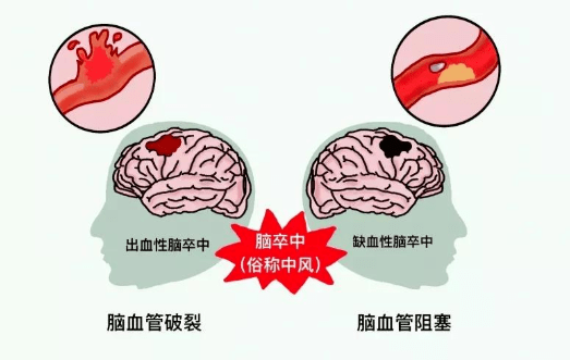 症状|世界卒中日:警惕卒中症状,尽早识别尽早救治,只为争取一线生机!