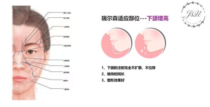 进行液态膨体 | 非术俏鼻精雕专属可降解骨性填充塑形材料