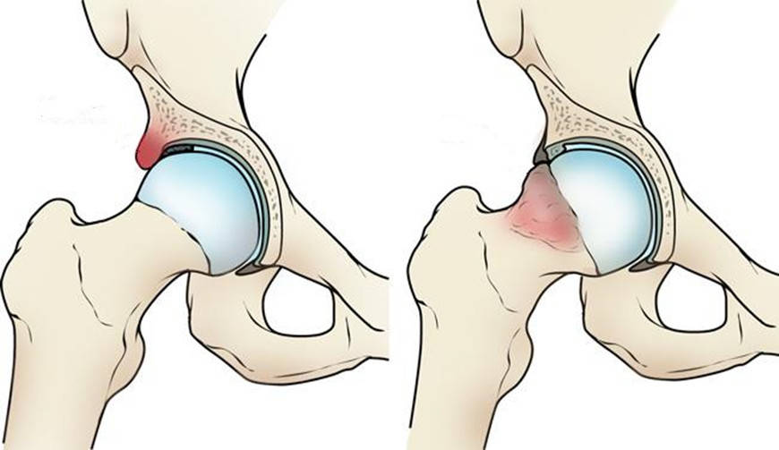 时间|20到50岁，不想做人工髋关节置换，保髋手术能撑多久？