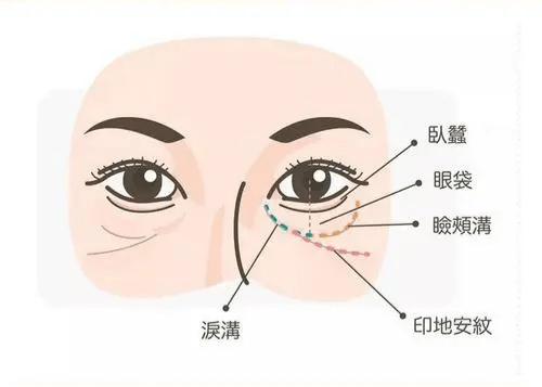 原因#印第安纹剥离 印第安纹怎么才能祛除？