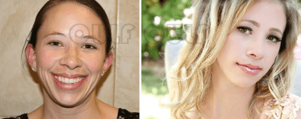 脸部专家科普:脸部做脂肪填充好吗?脸部脂肪填充安全吗?疑问解答~