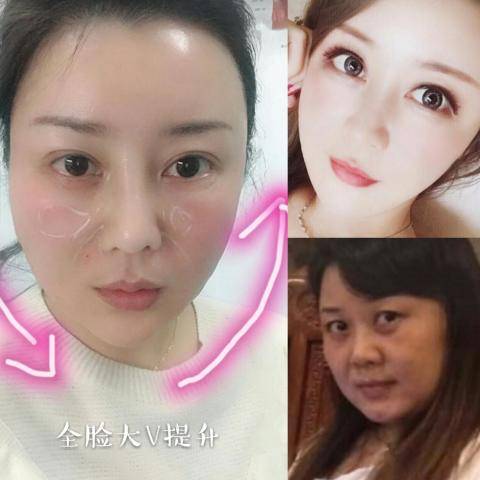 分析蛋白线雕有什么危害、您且听且分析~
