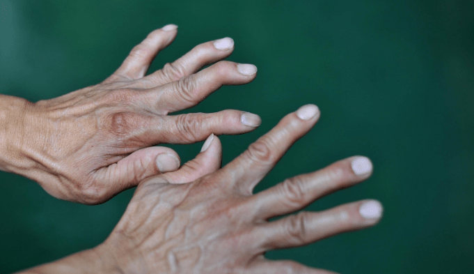 病患者|运动神经元病患者会出现这些症状