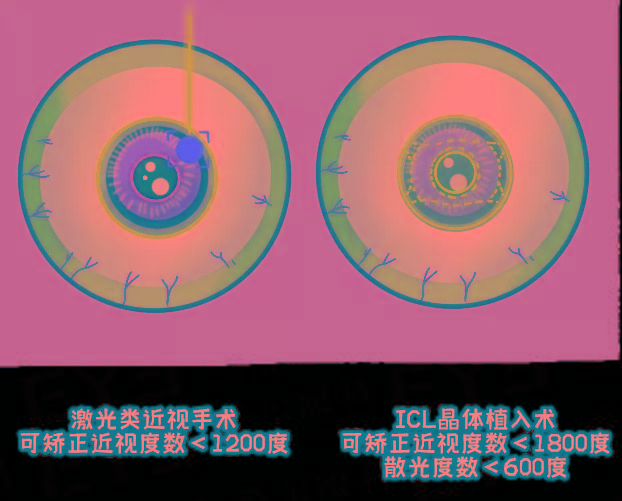 植入术|近视＞600度的人，必看！！！