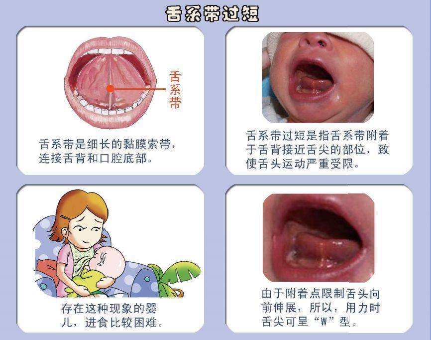 孩子舌系带短会影响他的说话吗？