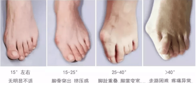 脚趾|上海健桥医院拇外翻侯明主任：拇外翻是—种病吗