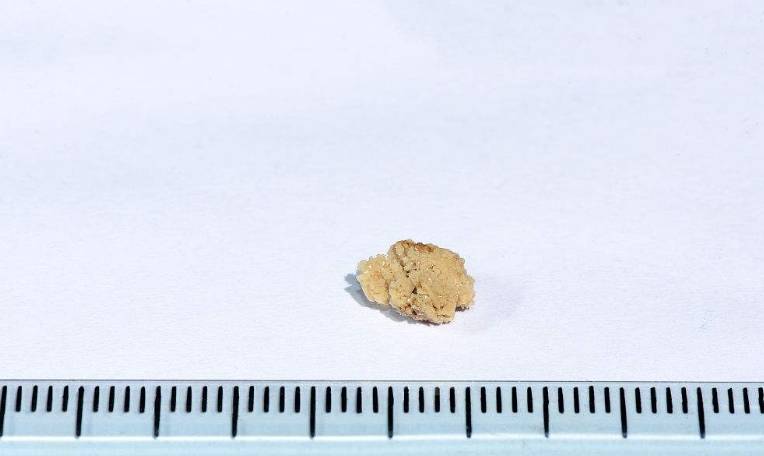 才会|肾结石突然疼是为什么?这几个症状说明肾结石严重化了