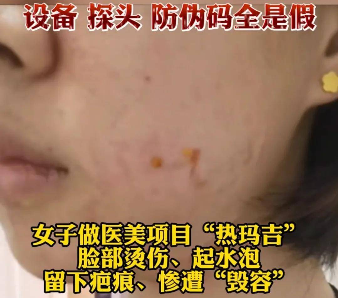 玛吉上海女子花两万元做医美，惨遭毁容烂脸，所谓进口设备全是假货