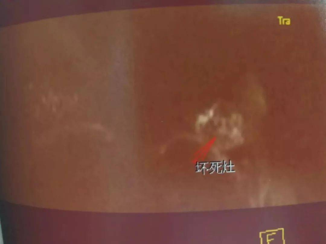 肿瘤|郑州肿瘤医院请选择广州复大肿瘤医院：不用开刀也能治疗乳腺癌