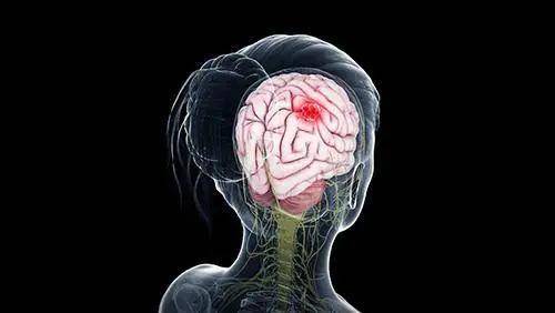 里长|脑袋里长这种瘤是不是100%没救了?看完这篇文章你就明白了！