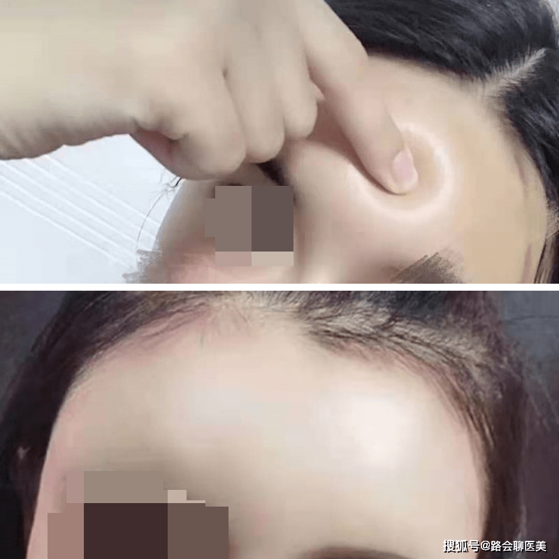 血管想做玻尿酸填充，看完这篇不走弯路