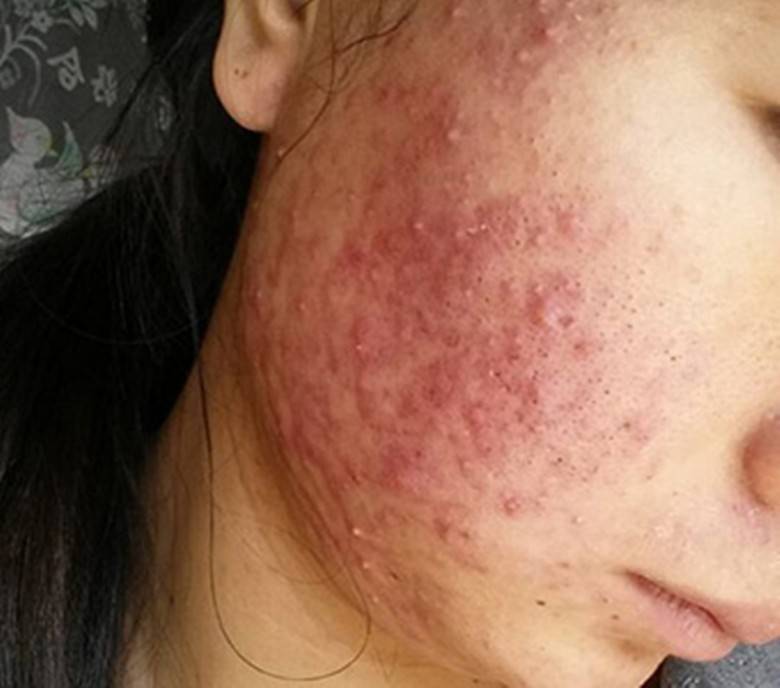 青春痘到底有多烦人?_治疗