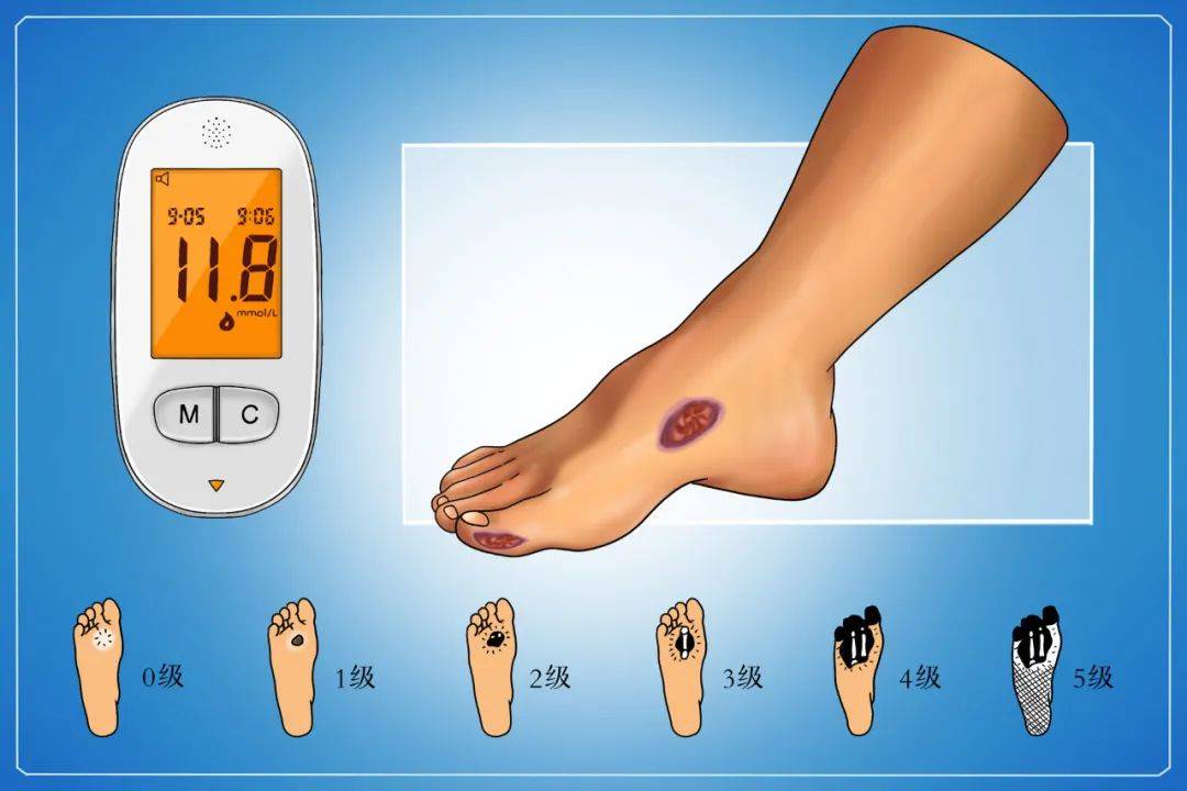 控制|如何做好糖尿病健康管理？记住五大口诀、运动“123579”