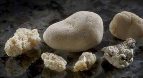 肾脏|肾结石来临时，身体会出现这些信号，别对此不屑一顾！