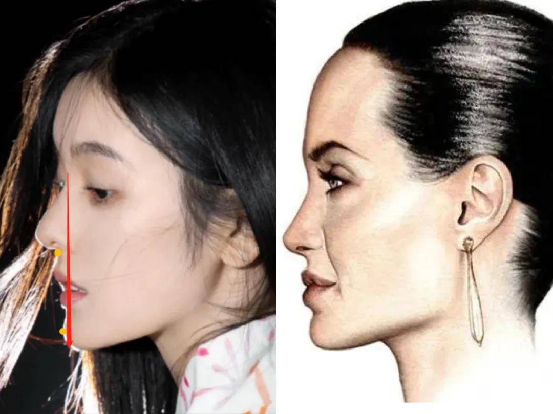 小怡是凸面下巴前倾,鼻下点和颏前点都在线前,这样的颌面对女生来说过