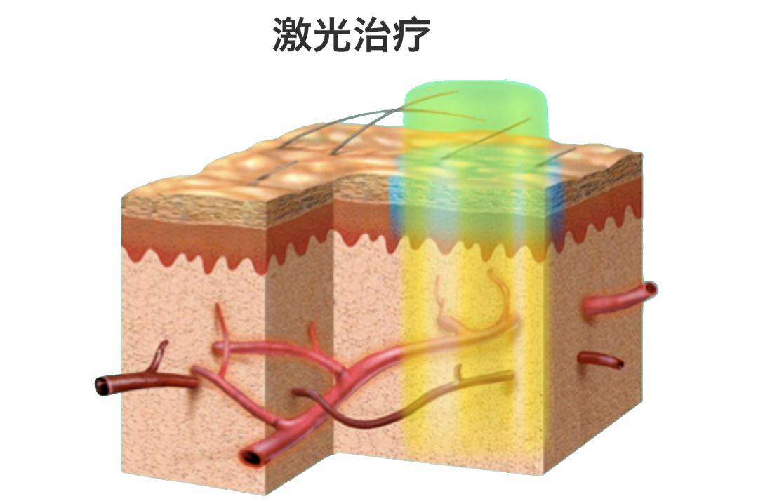 治疗如何消除红血丝？从护肤到医美，一篇给你讲透！