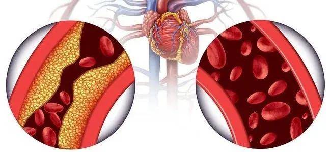水平|4成血脂异常！！国人健康何以为继？？