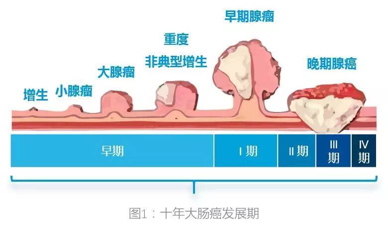 4种可能引发癌症的肠息肉看看消化医师怎么应对