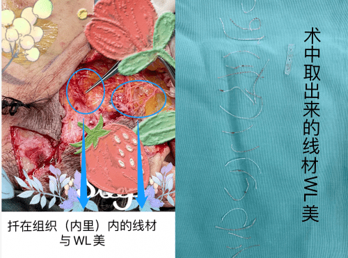 消息资讯|西安国际医学整形医院王志军教授 警惕！整形美容变毁容