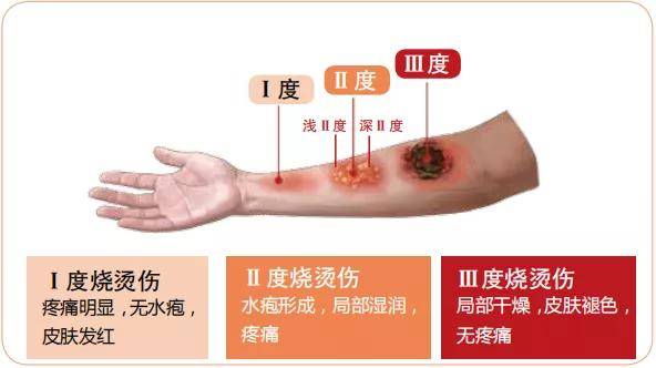 烫伤了怎么办 这个急救知识可以救命 却只有烧伤科医生知道 公益活动 阳光公益网