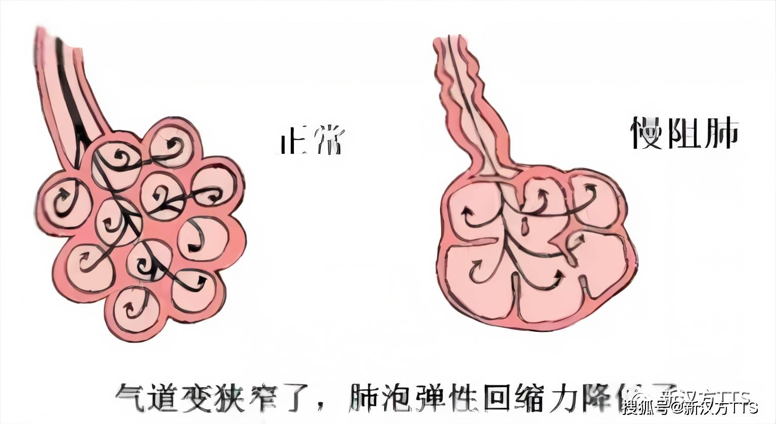 肺气泡能自愈吗 来自搜狐网