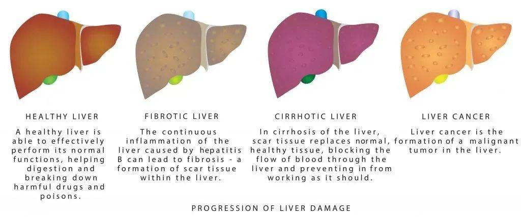 肝脏|肝脏疾病找上门,还在“香烟酒杯”不离手?