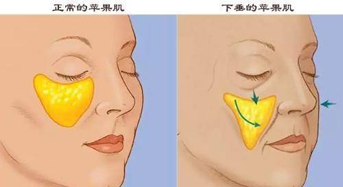 治疗如何防止面部苹果肌下垂和凹陷，一张图片告诉你