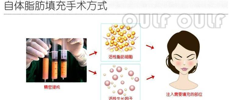 SVF-gel脂肪胶全脸填充要多少钱，要3万块钱是不是有点贵~