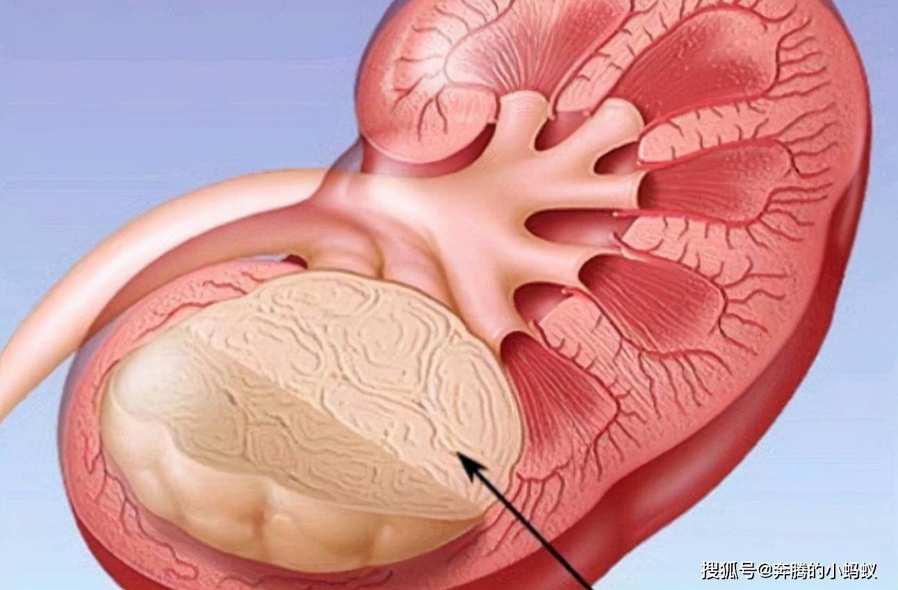 如何讓腎囊腫自動消失馬上教你真的很簡單