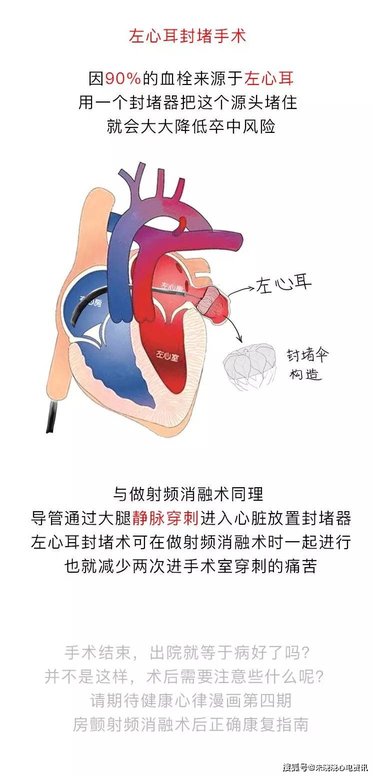 房颤|你了解房颤吗?一文图解掌握