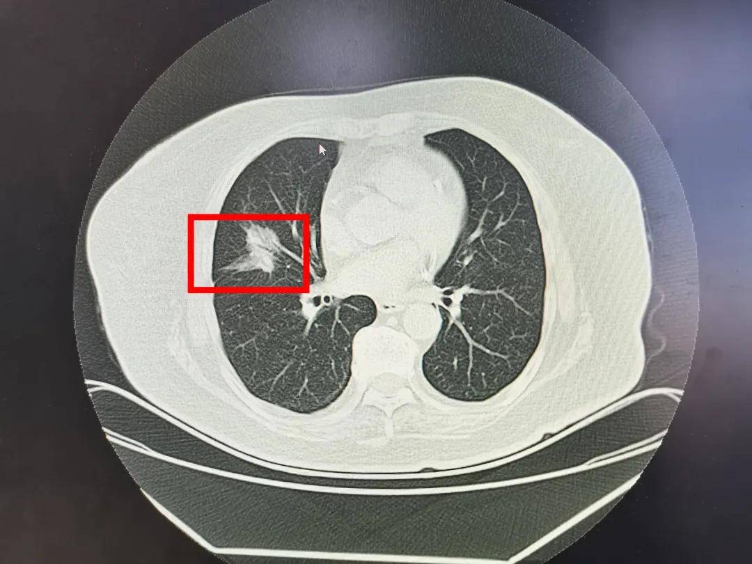 78岁患肺癌,做手术有必要吗?
