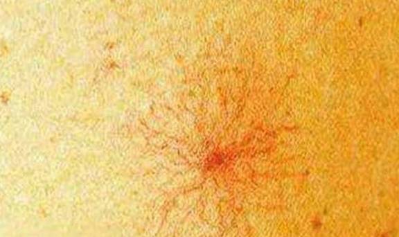 肝脏|这2个习惯是伤肝“加速器”，身体有2红、2痛，快查肝功能