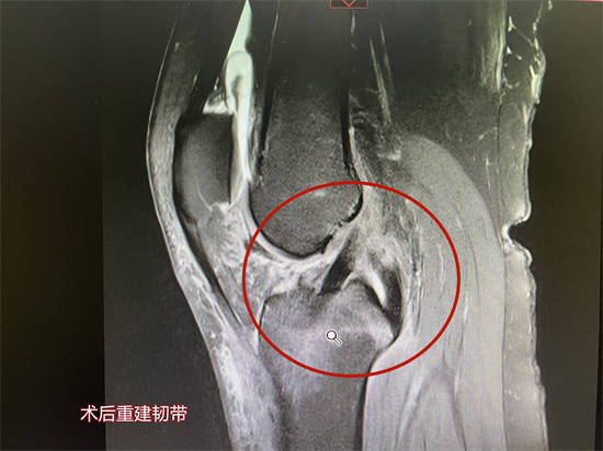 且"动"且珍"膝",膝关节损伤不可逆——前交叉韧带断裂!_阿姨
